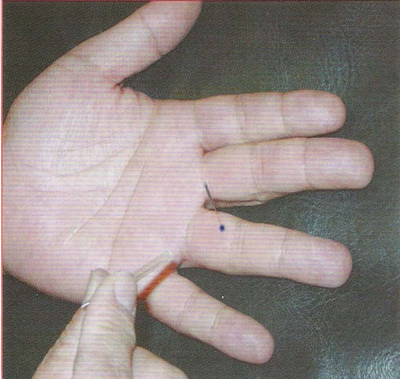 董氏奇穴-三眼穴