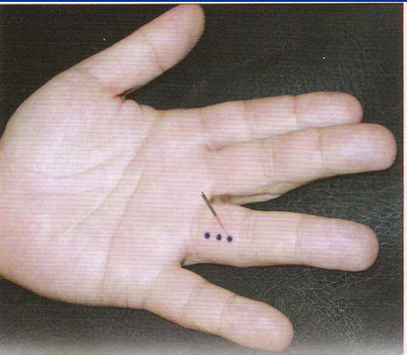 董氏奇穴-复原穴