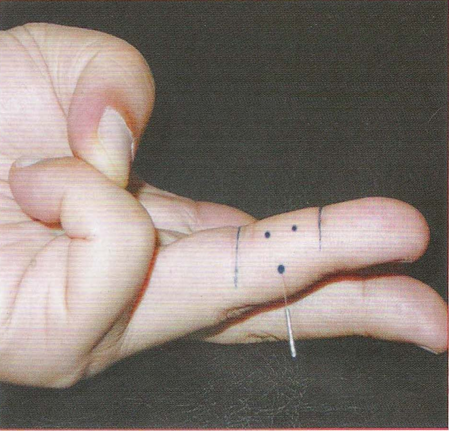 董氏奇穴-还巢穴