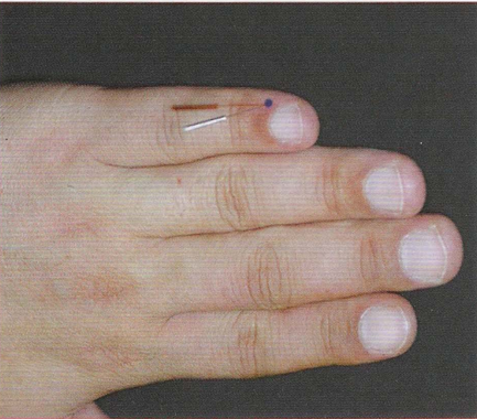 董氏奇穴-火膝穴