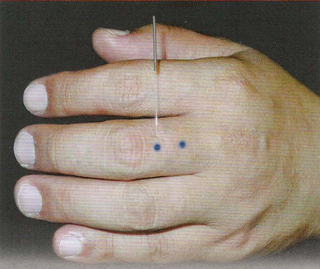 董氏奇穴-二角明穴